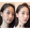 青岛取痘_菏泽取痘/青岛宏痣翔