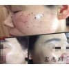 莱西取斑_崂山取斑培训/青岛宏痣翔